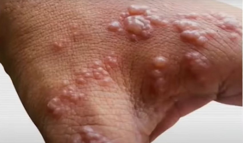Majmunske boginje mogu se širiti i prije pojave simptoma